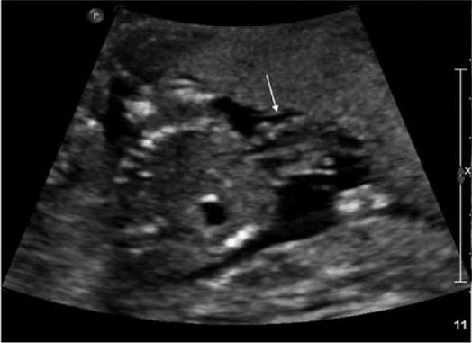 <p>partial or complete displacement of heart outside of the thorax</p>