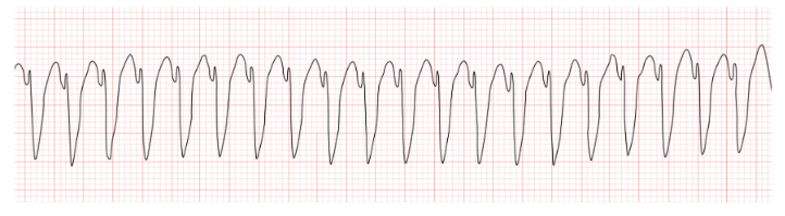 <p>An EKG technician is analyzing the rhythm strip shown here. Based on direct observation of the tracing, the technician notes the regularity of the rhythm, the appearance of the QRS complexes, and the absence of identifiable P waves. Which of the following is the correct interpretation?</p>