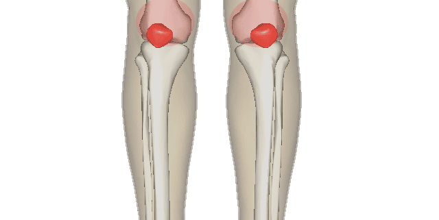 <p>Patellofemoral </p>