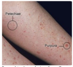 <p>Acute or chronic platelet count < 150,000 d/t destruction, decreased production, or drug suppression</p><p>- educate on fall risk, modify MSK exam and therex d/t risk of bleeding</p>