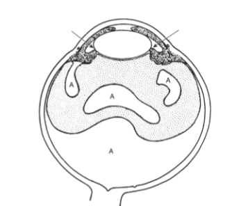 <p>A rare cause of secondary angle closure in which aqueous humor is misdirected posteriorly into or behind the vitreous, increasing vitreous volume and pushing the entire lens–iris diaphragm forward.</p>