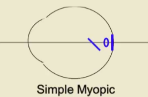 <p>Clinical Classification of Astigmatism based on focal points</p>