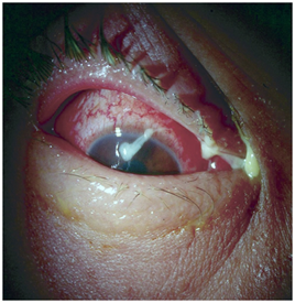 <p>Causative Agent: Chlamydia trachomatis fluid transmission to eyes.</p>