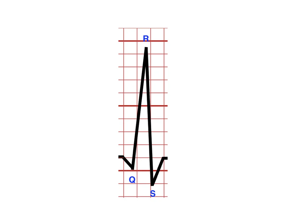 <p>QRS complex</p>