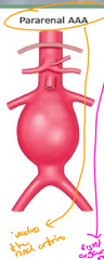 <p>Pararenal AAA</p>