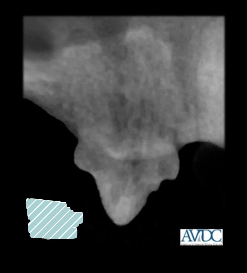 <p>what stage of tooth resorption is this?</p>