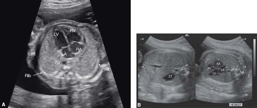 <p>The apex of the heart will be angled to the left of the midline (same side as stomach as well), with the base closest to the spine.</p>
