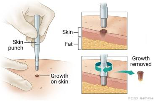 <p>ANSWER: Punch biopsy gives substantial depth but relatively little surface epithelium, making it less helpful for evaluating epithelial dysplasia. It is better suited to skin, soft-tissue, and salivary lesions. The lecture notes that oral pathologists generally prefer scalpel biopsies.</p>
