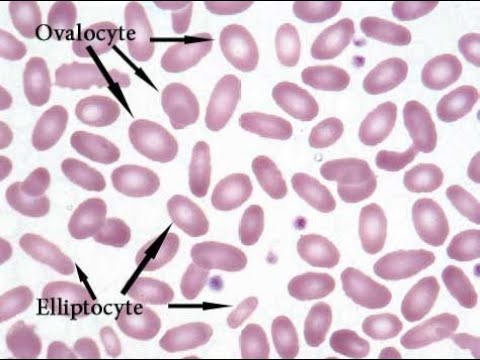 <p>ovalocytes</p>