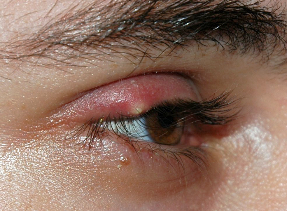 <p>stye</p>