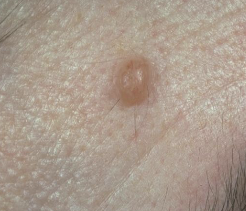 <p>a small, circumscribed lesion usually <1cm in diameter that is elevated or protrudes above the surface of normal surrounding tissue </p>