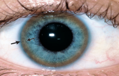 <p>golden/red/brown ring from copper deposition in individuals with Wilson's disease</p>