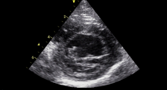 <p>What does this echocardiogram show?</p>