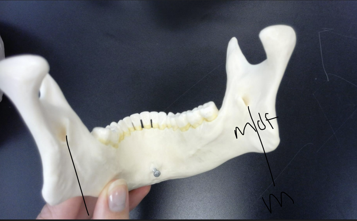 <p>mandibular foramen of the mandible</p>