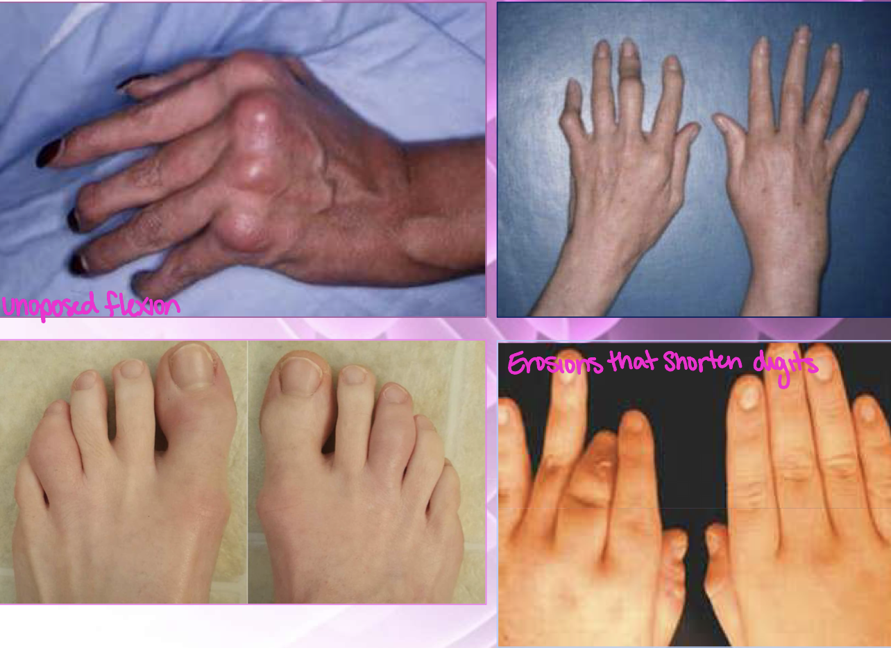 <p>Psoriatic arthritis commonly starts as dramatic effects in</p>