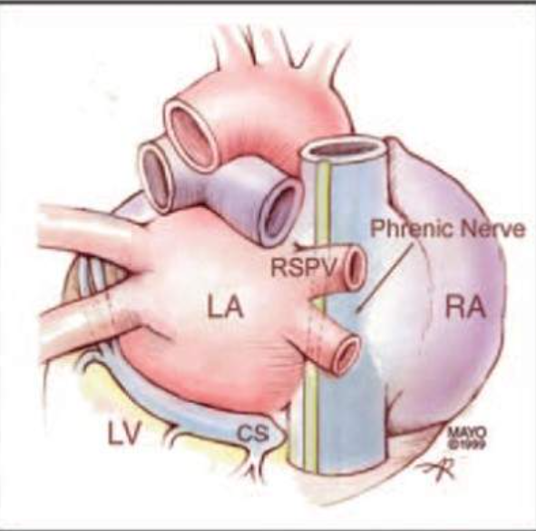 <p>runs anterior to the right superior pulmonary vein </p>