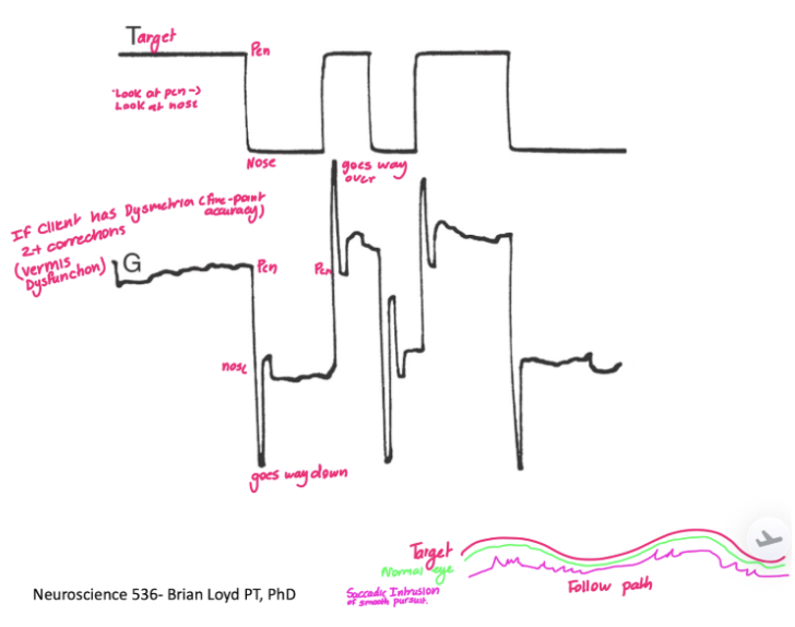 <ul><li><p><span style="background-color: transparent; font-family: "Times New Roman", serif;">In normal vision what asking to look at a pen and nose there is a smooth transition between the two&nbsp;</span></p></li><li><p><span style="background-color: transparent; font-family: "Times New Roman", serif;">In basal ganglia dysfunction we would expect to see dysmetria (difficulty with fine-point accuracy, with 2+ corrections)</span></p></li><li><p><span style="background-color: transparent; font-family: "Times New Roman", serif;">This is associated with the vermis in the cerebrum.&nbsp;</span></p></li></ul><p></p>