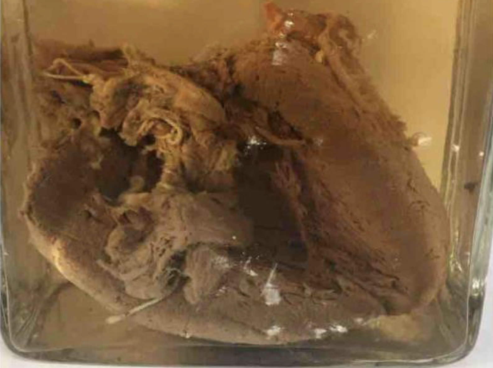 <p>Pathologic condition and cellular adaptive change associated with this specimen</p>