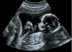 <p>Ultrasonography</p>
