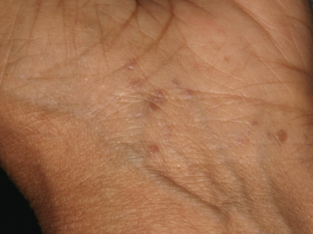 <p>What condition?</p><p>• Purple, polygonal, pruritic papules</p><p>• Develops on flexor surfaces of extremities</p>