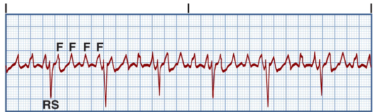 <p>Atrial Flutter</p><ul><li><p>rate?</p></li><li><p>P wave</p></li><li><p>PR</p></li><li><p>Atrial oscillations</p></li><li><p>must calculate what (2)</p></li><li><p>associated with (1)</p></li><li><p>s/s result from ___ which causes __</p></li><li><p>increased risk of ___</p></li></ul><p></p>