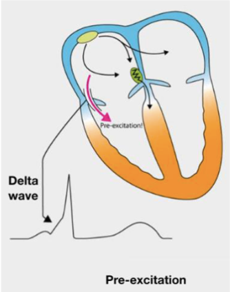 <p>Delta waves = slurred, slow upstroke in the initial part of the QRS complex</p>