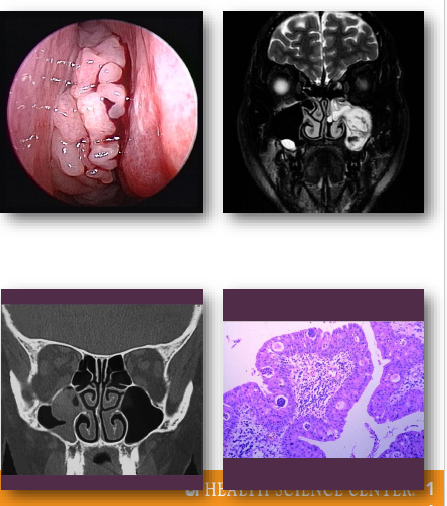 <ul><li><p>Benign epithelial tumors of sinonasal mucosa</p></li></ul><p>•Includes inverted and exophytic variants</p><p>•Associated with HPV infection in some cases</p><p>•Locally aggressive with recurrence potential</p><p>•Small risk of malignant transformation exists</p><p></p>