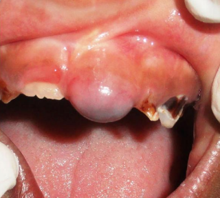 <p>7-year old male patient, which presented as a swelling involving the gingiva overlying the crown of 21</p>