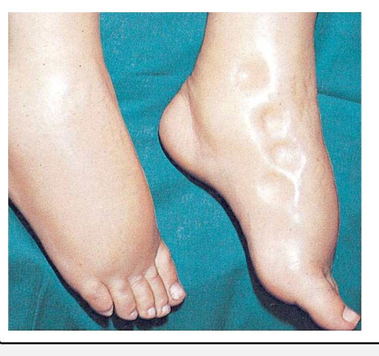 <ul><li><p>A finger pressed into the skin over an accumulation of fluid resulting in a temporary depression in the skin</p></li><li><p>Normal skin and subcutaneous tissues quickly rebound when the pressure is released.</p></li></ul><p></p>