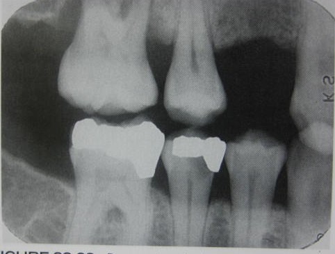 <p>what type of restoration is this </p>