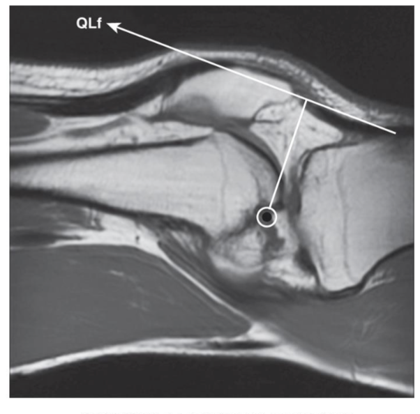 <p><span><strong>Patella</strong></span></p><ul><li><p><span>Anatomical pulley to increase MA of Quads</span></p></li><li><p><span>Peak MA and peak force (length/tension) occur between 45 and 60 deg of flexion</span></p><ul><li><p><span><strong>Impact on torque production: </strong>45-60 dg have a lot of force from quads</span></p></li></ul></li></ul><p></p><ul><li><p>No patella → smaller MA needing more force from quads </p></li></ul><p></p>