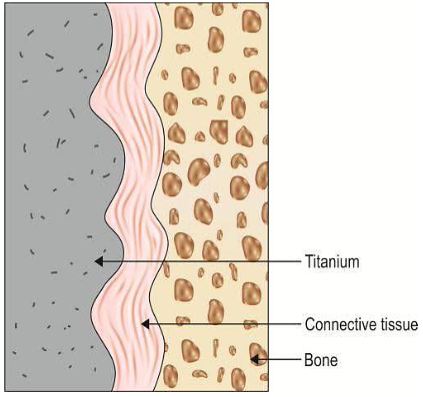 <ul><li><p><span>Is defined as “tissue to implant contact by interposition of a healthy </span><span style="color: rgb(255, 0, 0);">dense collagenous tissue </span><span>between the implant and the bone interface”.</span></p></li><li><p><span>Attributed to proliferation of connective tissue into the interface.</span></p></li><li><p><span>Not desirable since union is </span><span style="color: rgb(255, 0, 0);">WEAK</span><span>.</span></p></li></ul><p></p>