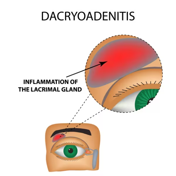 <p>PP: inflammation of lacrimal gland</p><p>E: m/c→inflammation<br>mumps<br>mono<br>influenza<br>bx (rare)</p><p>CM: erythematous tender swelling of outer 1/3 of upper eyelid</p><p>TX:<br>NP: cool compress<br>calm inflammation</p><p>MX: abx<br>steroids</p>