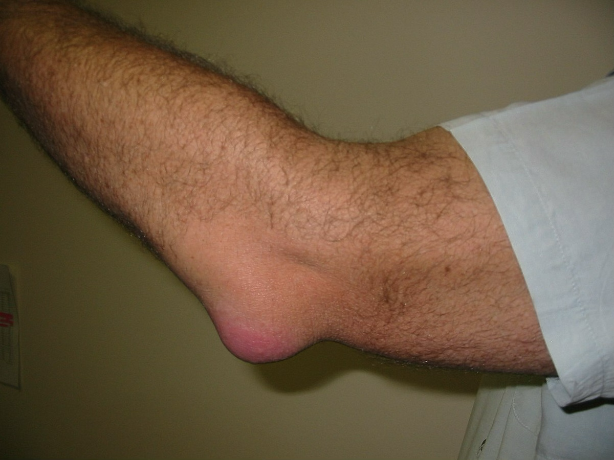 <p>olecranon bursitis</p>