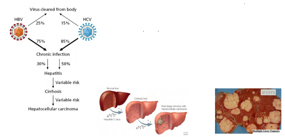 <p>Hepatocellular carcinoma can be caused by HBV or HCV infection</p>