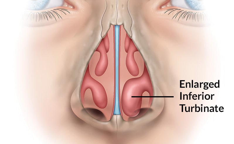 <p>Nasal turbinates (conchae) (facial bones)</p><p><em>(KON kee)</em></p>