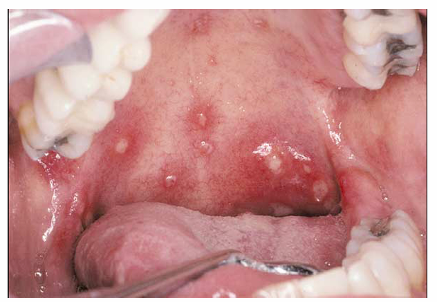 <p>1.what is this lesion?</p><p>2. how to treat/ manage it?</p><p>3. classification of oral lesion in HIV?</p>