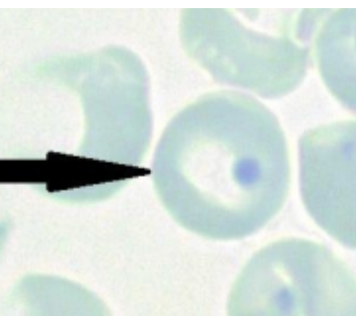 <p>Heinz bodies, inclusions comes from denatured (HgB inside the rbc). </p>