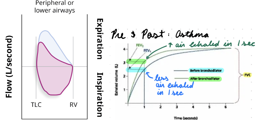 <p>Spirometry: </p><ul><li><p>Airflow obstruction (flow-volume loop scooping)</p></li><li><p>Pre- and post- bronchodilator administration</p></li></ul><p>Peak Expiratory Flow (PEF):</p><ul><li><p>Max speed when forcibly exhaling air</p></li><li><p>Supportive</p></li></ul><p>NO IMAGING</p>
