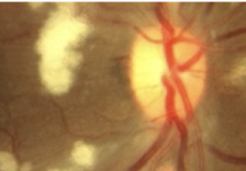 <p>True or False: CWS occur with both HTN and diabetic retinopathy.</p>
