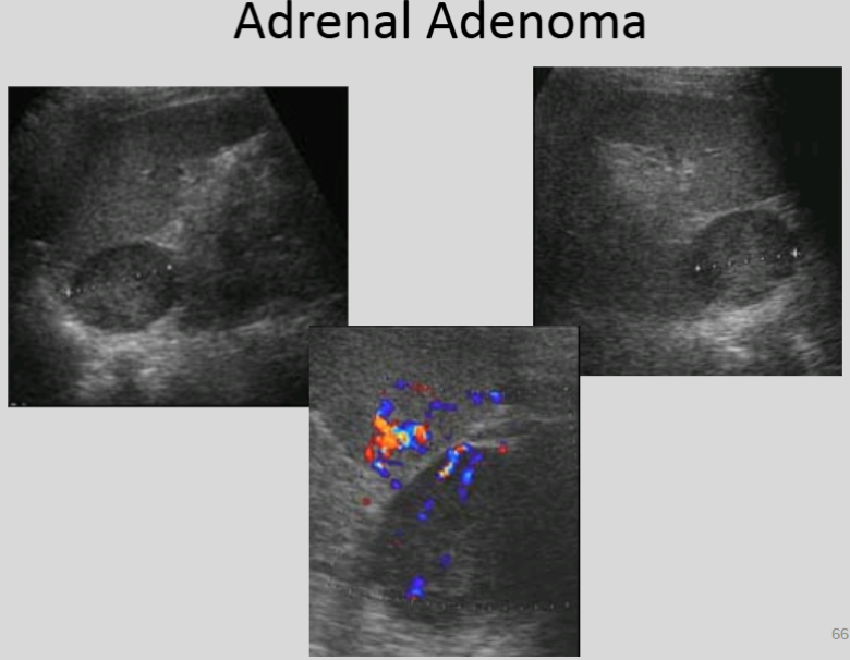 <p>What patient population is going to have a higher incidence of having an adrenal adenoma?</p>