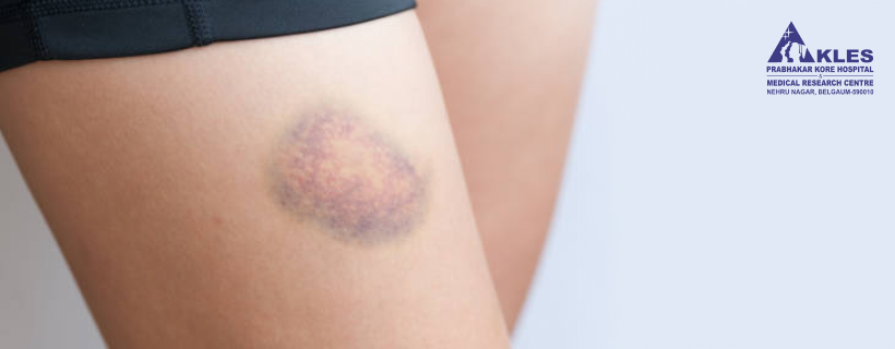 <p>common bruise </p>