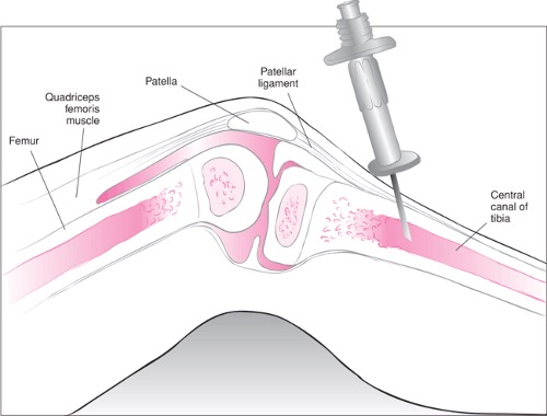 <p>injected into the bone marrow cavity ( can't admin.)</p>