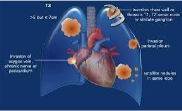 <p><strong><u>>5-7 cm</u></strong></p><p>OR invading:</p><ul><li><p>Chest wall</p><ul><li><p>Thoracic T1, T2 nerve roots</p></li><li><p>Stellate ganglion</p></li></ul></li><li><p>Phrenic nerve, azygos vein</p></li><li><p>Parietal pleura</p></li><li><p>Pericardium</p></li></ul><p>OR separate tumor nodule(s) in the <strong><u>same lobe</u></strong></p>