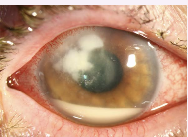 <p>What is this condition and describe?</p>