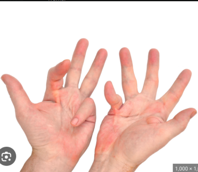 <p>A permanent tightening of the muscles, tendons, skin, and nearby tissues that causes the joints to shorten and become very stiff.</p>