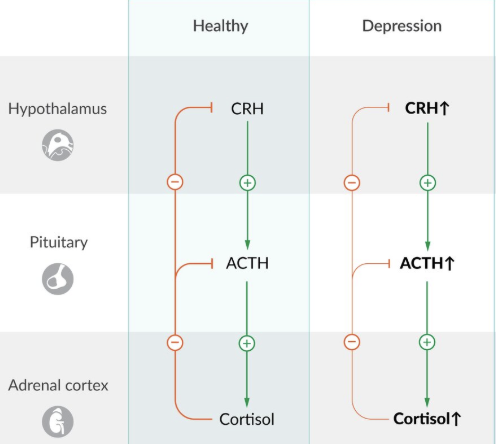 <ol><li><p>Stress = Activate HPA axis</p></li></ol><ul><li><p>Increase CRH (hypothalamus) → Increase ACTH (anterior pituitary) → Increase cortisol (adrenal cortex)</p></li><li><p>Negative feedback = Inhibit hypothalamus + anterior pituitary</p></li></ul><ol start="2"><li><p>Chronic stress = Decrease glucocorticoid receptors in hypothalamus + anterior pituitary (resistance) = No negative feedback from glucocorticoids (cortisol)</p></li><li><p>Continued CRH release = Cause…</p></li></ol><ul><li><p>Hippocampal damage = Mood dysregulation + cognitive dysfunction</p></li><li><p>Neuroinflammation</p></li><li><p>Frontolimbic disconnection</p></li></ul><p></p>
