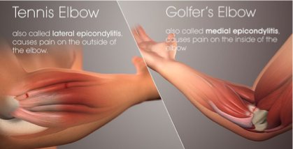 <p>golfers elbow </p>