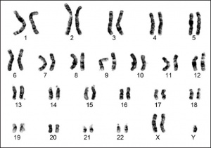 <ul><li><p>Klinefleter syndrome (XXY) </p></li><li><p><span>Genetically male as they possess a Y chromosome</span></p></li><li><p><span>Sterile (undeveloped testes), taller than average height</span></p></li><li><p><span>Feminisation of secondary sexual characteristics</span></p></li></ul><p>EG Breast development, reduced facial and body hair</p><p></p>