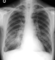 <p>This x-ray image indicates what pathology?</p>